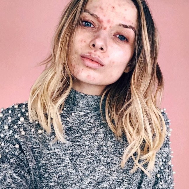 Beauty vlogger ini sempat viral karena wajahnya yang berjerawat. Oleh netizen ia diejek menjijikan karena penampilan jerawatnya yang hampir satu wajah. Namun ketika sudah makeup, maka kamu bisa jadi minder. Foto: Dok. Instagram/Em Ford