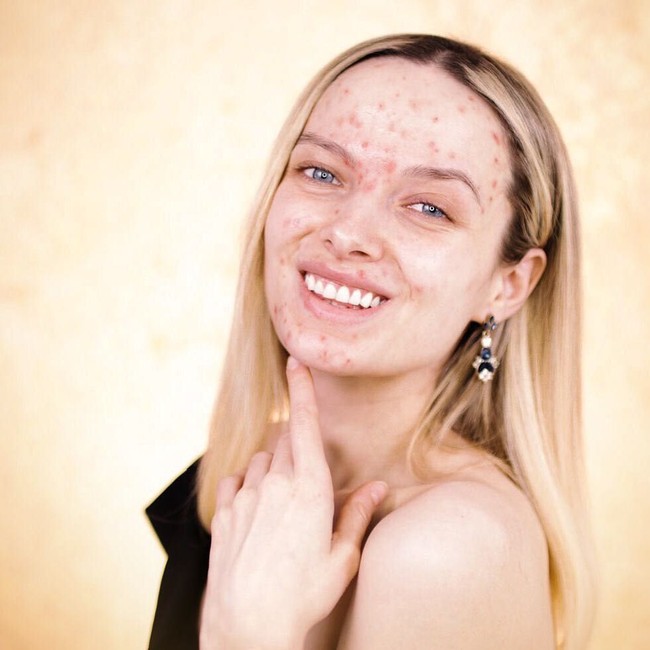 Masa-masa terpuruk karena jerawat pun pernah dilalui oleh Em. Jerawat meruntuhkan kepercayaan dirinya. Foto: Dok. Instagram/Em Ford