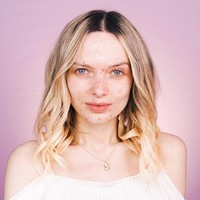 Aku nggak pernah membayangkan jadi blogger atau posting selfie di media sosial layaknya millennial noram. Kamu tahu kan, kalau kamu punya jerawat pasti ada saja orang yang membicarakan jerawatmu. Itu yang membuatku tak nyaman keluar rumah dan dan tak nyaman dengan diriku sendiri, kata Em kepada Glamour.  Foto: Dok. Instagram/Em Ford