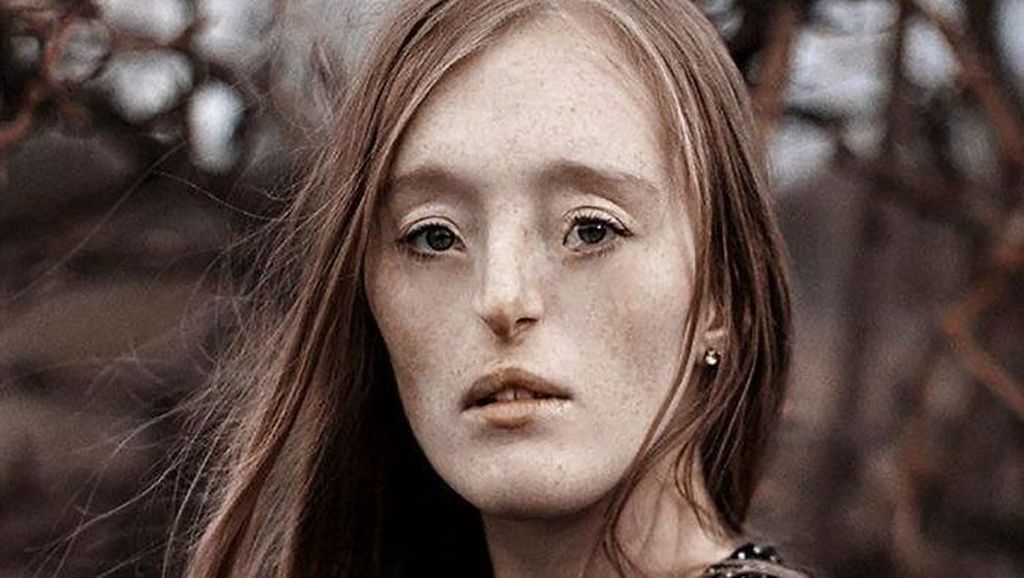 Tersentuh Foto-foto Indah Wanita yang Terlahir dengan Bibir Sumbing Tersentuh Foto-foto Indah Wanita yang Terlahir dengan Bibir Sumbi ng