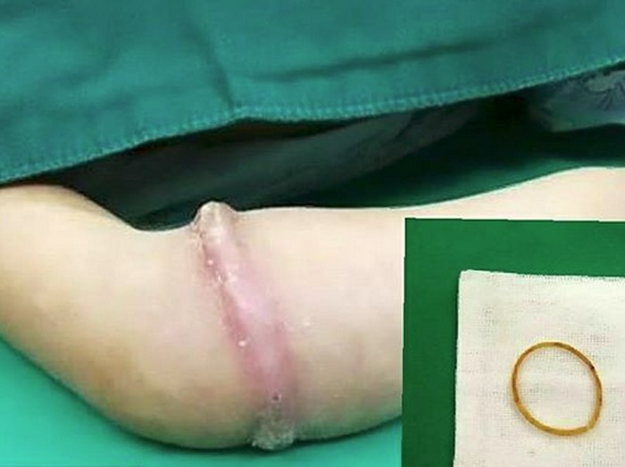 Karet yang menjadi daging di lengan bocah perempuan ini. Foto: Instagram Karet yang menjadi daging di lengan bocah perempuan ini. Foto: Instagram
