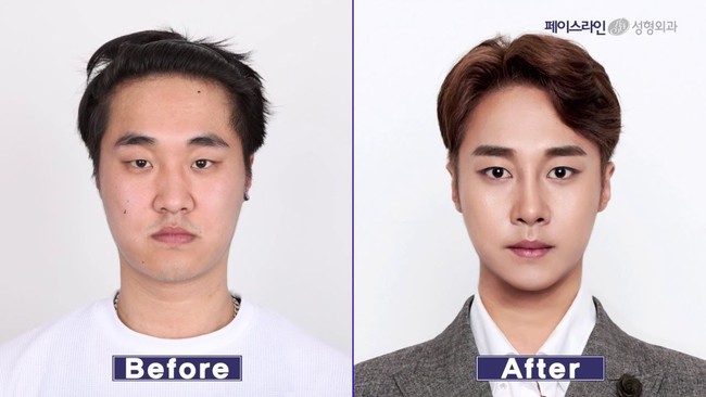 Pria ini merekonstruksi bentuk mata, hidung dan rahangnya jadi lebih V-shape atau oval. Bentuk wajah yang dianggap ideal untuk orang Korea. Foto: dok. Koreaboo