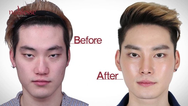 Sebelumnya mata pria ini terlihat lelah dan kuyu. Setelah operasi mata dan bentuk wajah, ia tampak lebih segar. Foto: dok. Koreaboo