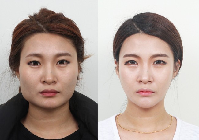 Hanya dengan mengubah bentuk rahang yang persegi jadi oval, wajah wanita ini berubah drastis. Foto: dok. Koreaboo