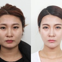 Hanya dengan mengubah bentuk rahang yang persegi jadi oval, wajah wanita ini berubah drastis. Foto: dok. Koreaboo