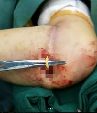 Pakai Karet Gelang di Lengan Selama 6 Bulan, Bocah Ini Dioperasi