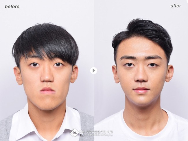 Pria ini juga mengubah rahangnya yang panjang jadi lebih proporsional. Foto: dok. Koreaboo