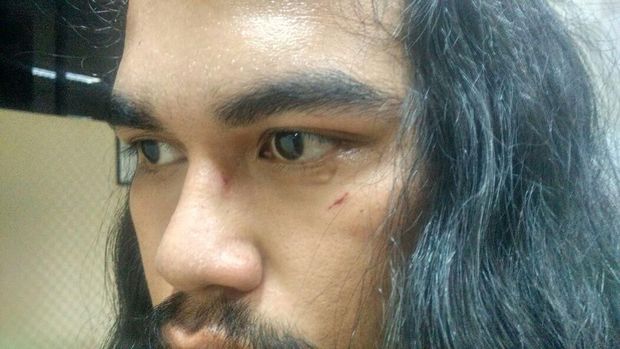 Ananda terluka di pelipis kirinya