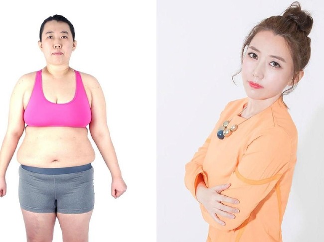 Operasi plastik sudah jadi hal lumrah di Korea Selatan, baik untuk kesehatan maupun estetika. Dikenal sebagai destinasi wisata medis untuk operasi plastik, begini transformasi para pasiennya yang bisa bikin kamu melongo melihatnya, seperti dilansir Koreaboo. Foto: dok. Koreaboo