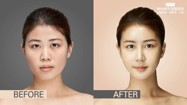 Wajah wanita ini diubah bentuk hidung dan rahangnya sehingga terlihat lebih mungil. Foto: dok. Koreaboo