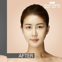 Wajah wanita ini diubah bentuk hidung dan rahangnya sehingga terlihat lebih mungil. Foto: dok. Koreaboo