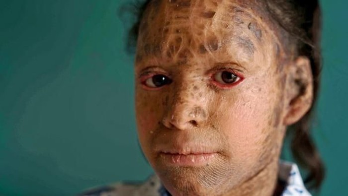 Kulit Vedika pecah-pecah dan terlihat seperti sisik karena ichthyosis. (Foto: Newslions/milaap) Kulit Vedika pecah-pecah dan terlihat seperti sisik karena ichthyosis. (Foto: Newslions/milaap)