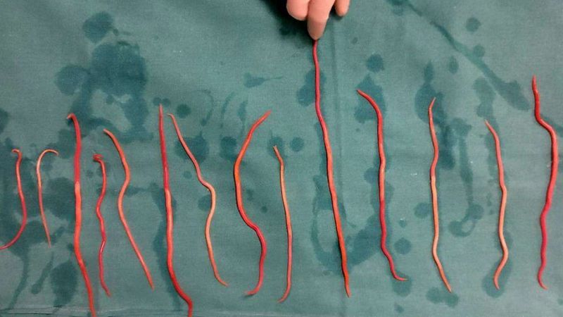 Cacing gelang di tubuh seorang wanita dari India.