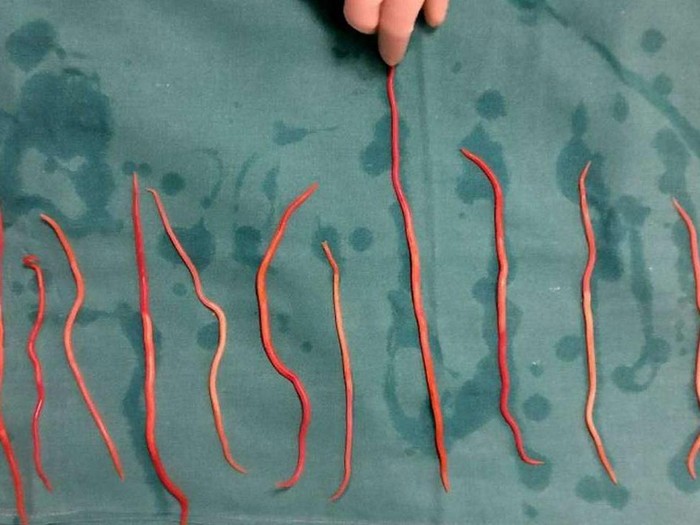Cacing gelang di tubuh seorang wanita dari India.