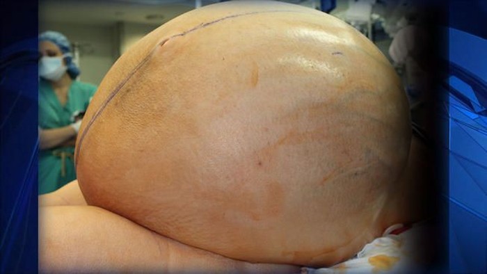 Butuh 12 Dokter untuk Angkat Tumor Raksasa 60 Kilogram dari Wanita Ini