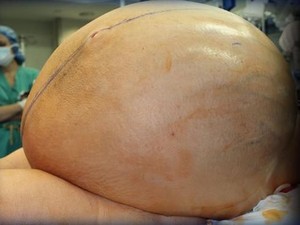 Butuh 12 Dokter untuk Angkat Tumor Raksasa 60 Kilogram dari Wanita Ini