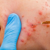 Awal 2000-an, hadir teknologi yang makin canggih untuk membasmi jerawat, seperti yang kita ketahui saat ini. Perawatan mulai dari facial, ekstraksi komedo dan jerawat, hingga suntik kortikosteroid untuk mengempiskan jerawat meradang dan bernanah.  Foto: Thinkstock