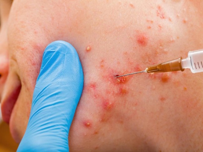 Awal 2000-an, hadir teknologi yang makin canggih untuk membasmi jerawat, seperti yang kita ketahui saat ini. Perawatan mulai dari facial, ekstraksi komedo dan jerawat, hingga suntik kortikosteroid untuk mengempiskan jerawat meradang dan bernanah.  Foto: Thinkstock