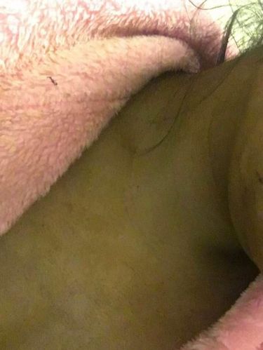 Ngeri! Pakai Krim Tanning Palsu, Kulit Wanita Ini Jadi Mirip Buto Ijo