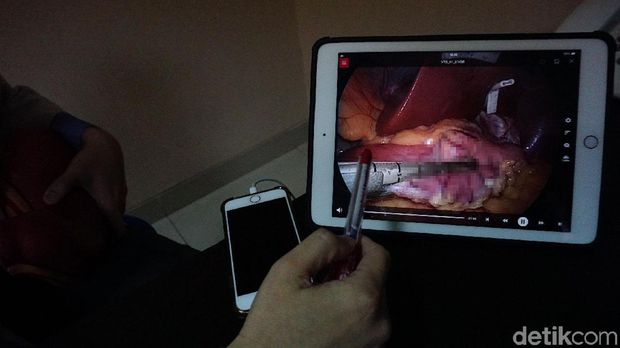 dr Handy menjelaskan mengenai operasi bedah bariatrik pada lambung.