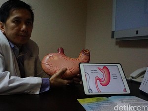 Macam-macam Operasi Bariatrik Lambung, Salah Satunya Dijalani Aria Permana