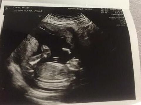 Bayi di dalam kandungan Nicole Gaunt
