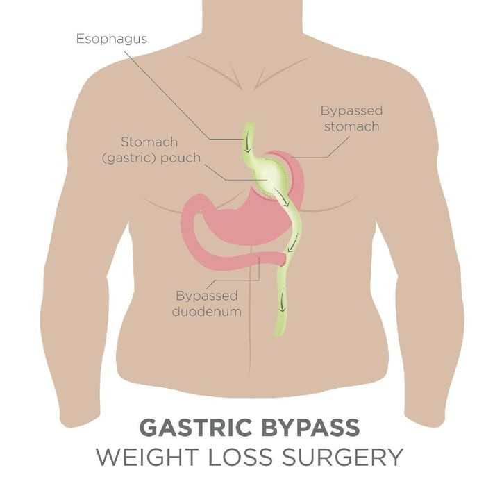 Gastric Bypass for Weight Loss