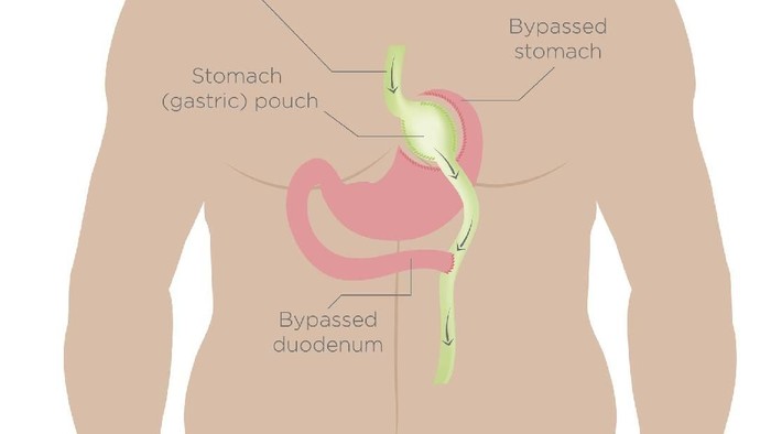 Salah satu prosedur operasi bariatrik lambung. Foto: Thinkstock Salah satu prosedur operasi bariatrik lambung. Foto: Thinkstock
