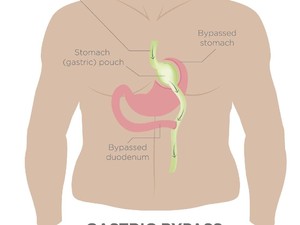 Tak Semua Kegemukan Butuh Operasi, Ini Anjuran Dokter Bedah