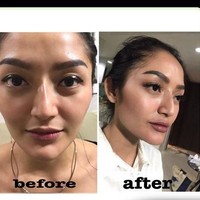 Artis berikutnya yang terang-terangan melakukan suntik filler di bibir adalah penyanyi dangdut Siti Badriah. Pedangdut yang populer dengan lagu Berondong Tua itu suntik filler di klinik kecantikan dr. Chen Aesthetic & Antiaging. Foto: Dok. Instagram dr. Chen Aesthetic & Antiaging