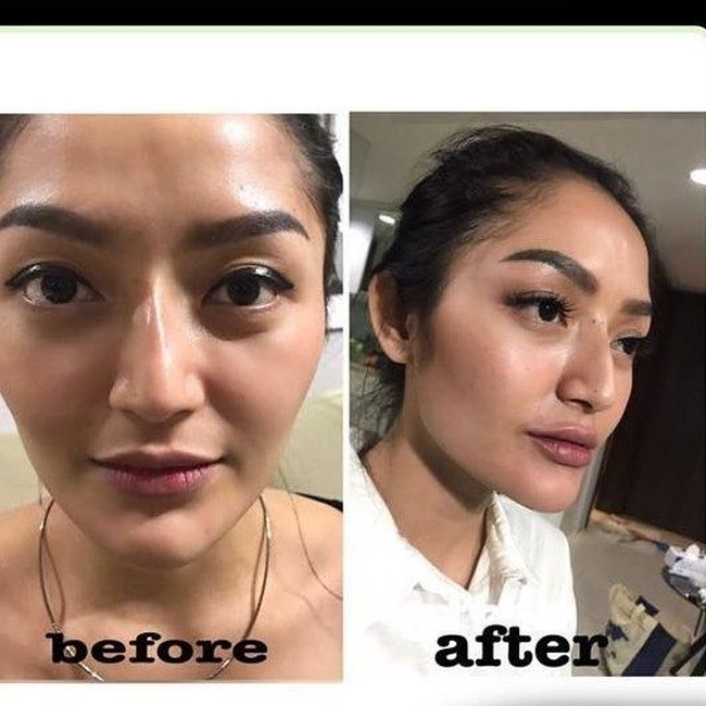 Artis berikutnya yang terang-terangan melakukan suntik filler di bibir adalah penyanyi dangdut Siti Badriah. Pedangdut yang populer dengan lagu Berondong Tua itu suntik filler di klinik kecantikan dr. Chen Aesthetic & Antiaging. Foto: Dok. Instagram dr. Chen Aesthetic & Antiaging