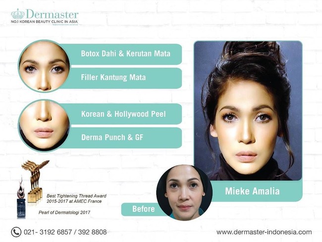 Aktris Mieke Amalia menjaga kecantikan wajahnya dengan melakukan suntik botox dan filler. Istri Tora Sudiro ini mendapatkan suntik botox di dahi untuk menghilangkan kerutan di area tersebut. Seperti terlihat dalam akun Instagram Klinik Dermaster, Mieke juga diketahui menjalani botox di area mata dan filler pada kantung mata.Foto: Instagram/Dermaster Indonesia