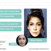 Aktris Mieke Amalia menjaga kecantikan wajahnya dengan melakukan suntik botox dan filler. Istri Tora Sudiro ini mendapatkan suntik botox di dahi untuk menghilangkan kerutan di area tersebut. Seperti terlihat dalam akun Instagram Klinik Dermaster, Mieke juga diketahui menjalani botox di area mata dan filler pada kantung mata.Foto: Instagram/Dermaster Indonesia