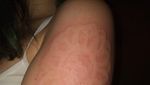 Dermatographia, Kondisi yang Bisa Bikin Tulisan Timbul di Permukaan Kulit