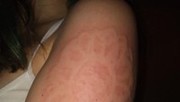 Tenang, untuk menggambar pada di kulit orang dermatographia tidak membutuhkan benda-benda tajam kok. Bisa dengan pensil berujung tumpul atau benda lainnya. Biasanya gambar akan menghilang dalam 30-60 menit. (Foto: Instagram/amy_dukaj)
