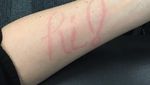 Dermatographia, Kondisi yang Bisa Bikin Tulisan Timbul di Permukaan Kulit
