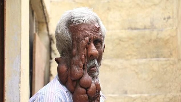 Subhash Chand (54) mengidap neurofibromatosis yang membuat wajahnya seakan meleleh. Meski begitu, Chand masih semangat menjalani hidup.Foto: Daily Mail Subhash Chand (54) mengidap neurofibromatosis yang membuat wajahnya seakan meleleh. Meski begitu, Chand masih semangat menjalani hidup.Foto: Daily Mail