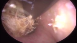 Ada alasan kenapa cotton bud tidak disarankan oleh dokter untuk membersihkan telinga. Foto-foto ini jadi contoh buktinya.