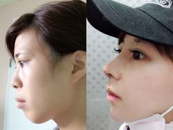 Transformasi Mengejutkan Wajah Cosplayer Pasca Oplas