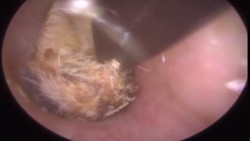 Ada alasan kenapa cotton bud tidak disarankan oleh dokter untuk membersihkan telinga. Foto-foto ini jadi contoh buktinya.