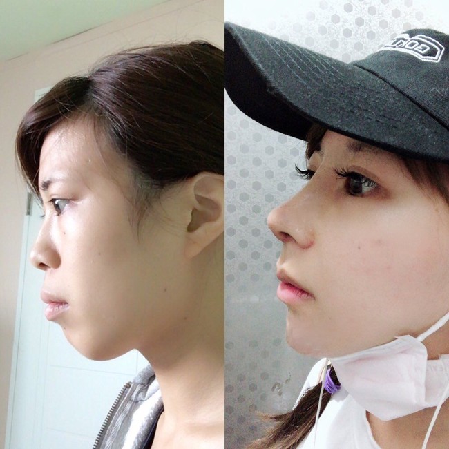 Ia pun telah menghabiskan lebih dari tujuh juta yen atau sekitar Rp 893 juta untuk operasi plastik. Foto: Twitter