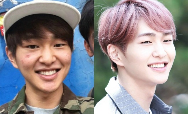 Member SHINee, Onew juga pernah memiliki masalah kulit dengan timbulnya bekas jerawat di pipi.  Foto: ist.