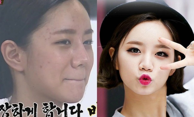 Girls Day Hyeri pernah memiliki beberapa bekas jerawat yang terlihat di kening dan pipinya. Foto: ist.
