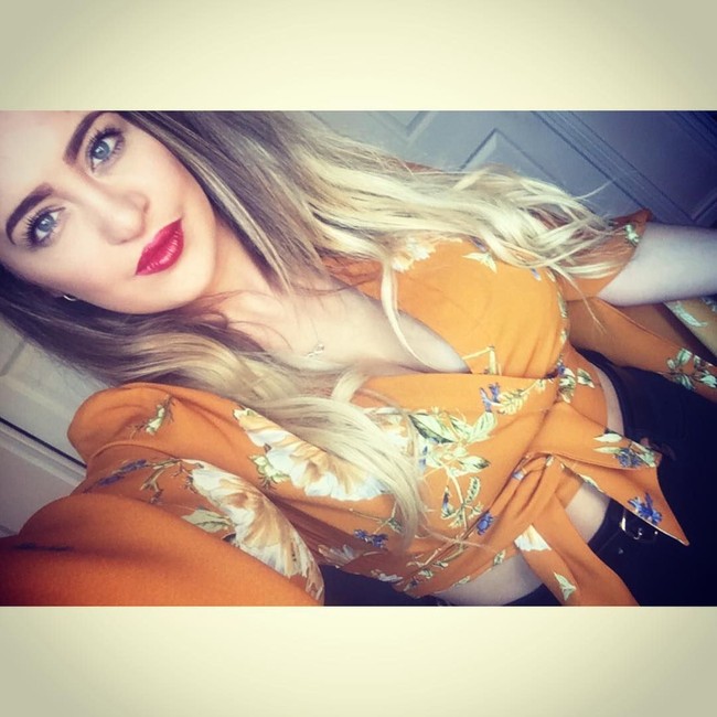 Operasi terbesarku adalah operasi rahang ganda di mana mereka memotong kedua sisi rahang, menariknya ke depan dan menempatkannya kembali ke posisi, rahangku lalu diikat dengan kawat gigi agar tidak berubah posisi, tutur Laura. Foto: Instagram Laura Hawkes