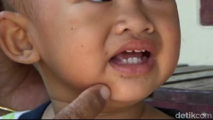 Dokter Bagikan Tips Perawatan di Rumah Bagi Anak yang Kena Flu Singapura