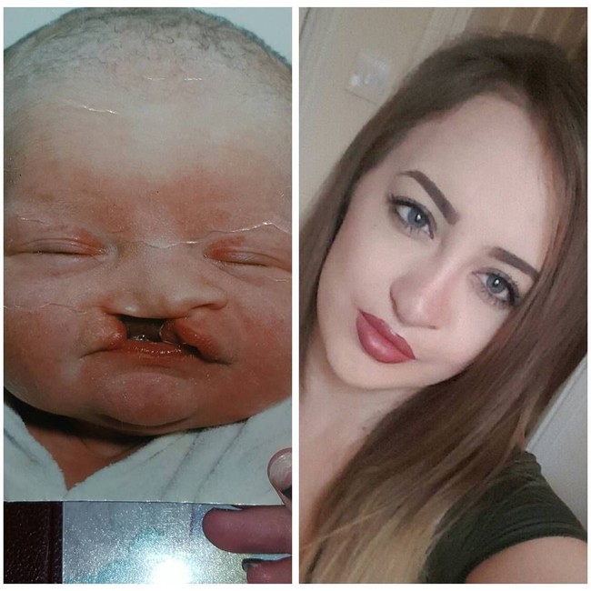 Lelah di-bully, wanita asal Inggris tersebut memutuskan untuk melakukan serangkaian operasi plastik sejak kecil. Foto: Instagram Laura Hawkes