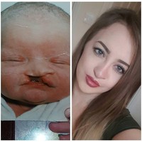 Lelah di-bully, wanita asal Inggris tersebut memutuskan untuk melakukan serangkaian operasi plastik sejak kecil. Foto: Instagram Laura Hawkes