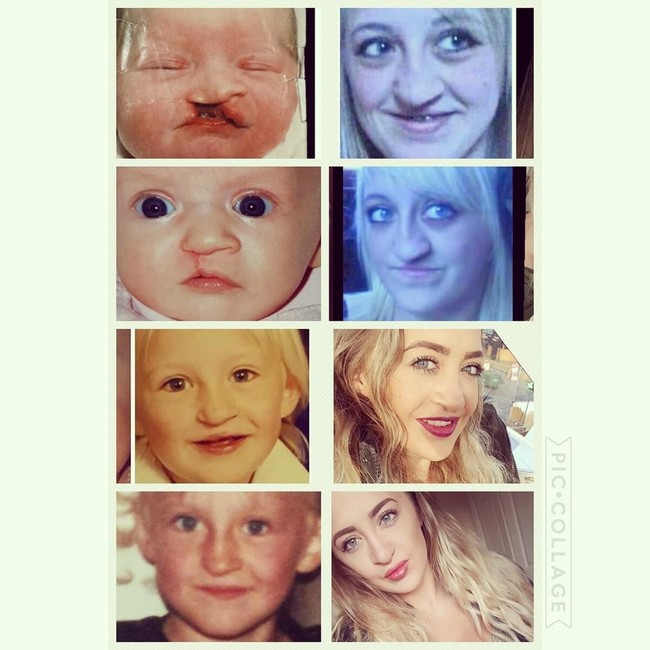 Seorang wanita bernama Laura Hawkes yang lahir dengan kondisi bibir sumbing mengalami pengalaman tidak menyenangkan sepanjang masa kecilnya. Laura sering menerima ledekan mengenai keadaan tubuhnya itu. Foto: Instagram Laura Hawkes