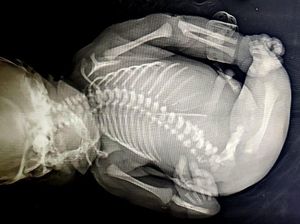 Bayi di India Lahir dengan Sindrom Putri Duyung Langka