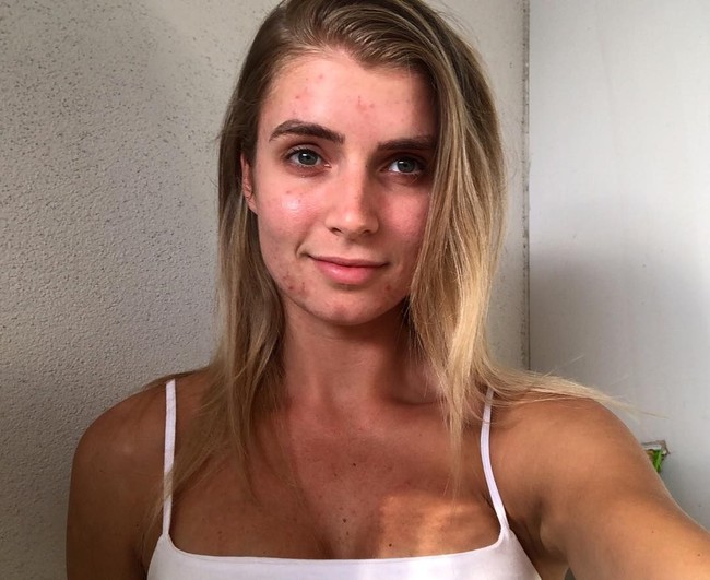 Beck Jackson tak takut menunjukkan bahwa wajahnya tak sempurna. Ia pun sering membagi foto selfie tanpa filter yang menunjukkan kondisi kulit berjerawat. Foto: Instagram @becklomas